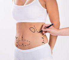 Liposuction